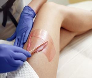 Epilation